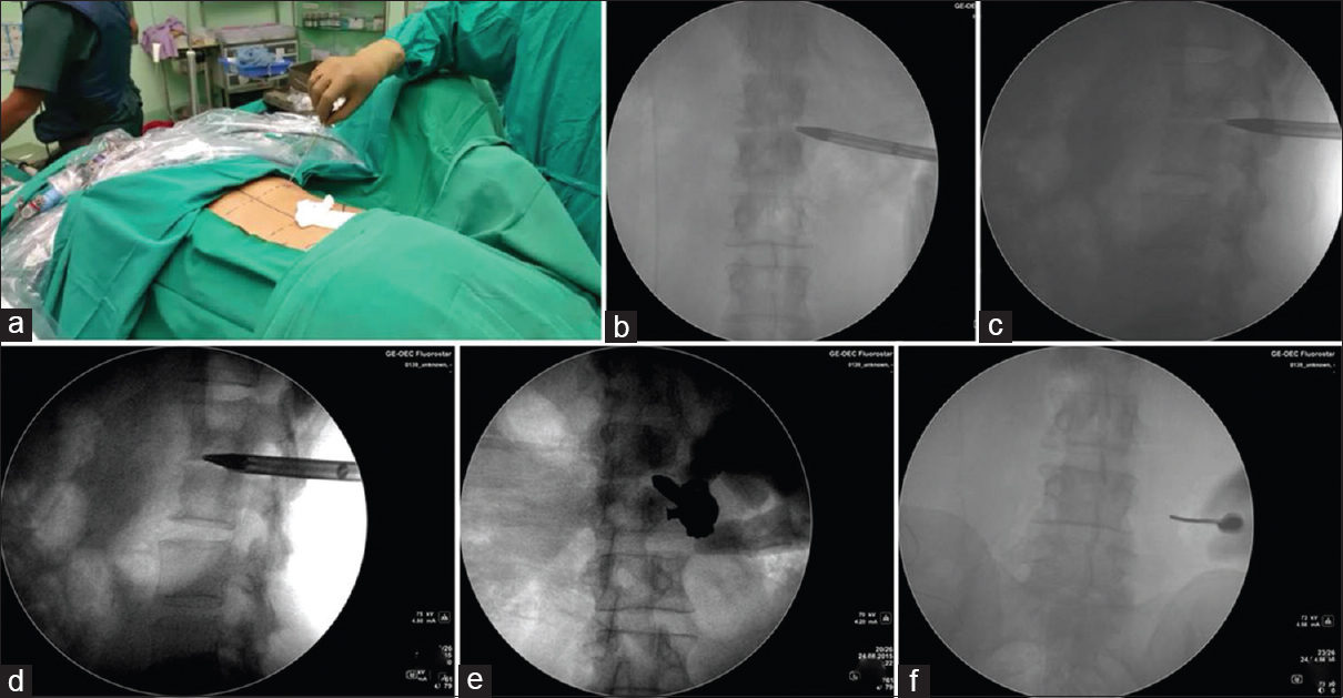 (a)Classic entry at 7 cm, 45°. (b and c) C-arm image showing trocar reached posterolateral corner, (d and e) Trocar followed by working sheath in center of disc, (f) Needle put paravertebral to guide the endoscope into psoas abscess